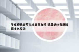 牛皮癣患者可以吃青黛丸吗 银屑病吃青黛胶囊多久见效