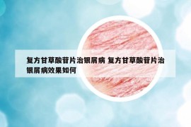 复方甘草酸苷片治银屑病 复方甘草酸苷片治银屑病效果如何