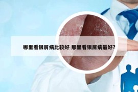 哪里看银屑病比较好 那里看银屑病最好?