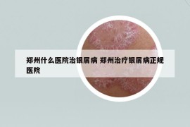 郑州什么医院治银屑病 郑州治疗银屑病正规医院