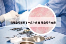 我耳朵后面长了一点牛皮癣 耳朵后有皮癣