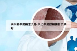 满头的牛皮癣怎么办 头上牛皮肤癣用什么药好