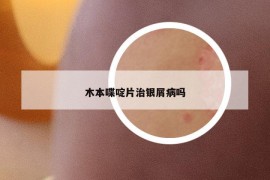 木本喋啶片治银屑病吗
