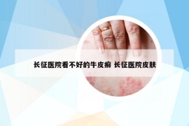 长征医院看不好的牛皮癣 长征医院皮肤