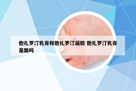 他扎罗汀乳膏和他扎罗汀凝胶 他扎罗汀乳膏是酸吗