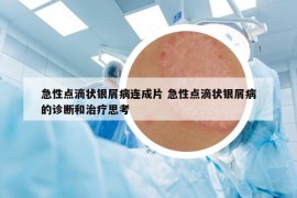 急性点滴状银屑病连成片 急性点滴状银屑病的诊断和治疗思考