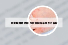 白斑病图片早期 白斑病图片早期怎么治疗