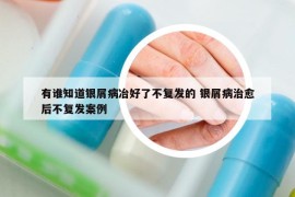 有谁知道银屑病冶好了不复发的 银屑病治愈后不复发案例