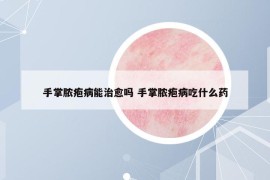 手掌脓疱病能治愈吗 手掌脓疱病吃什么药