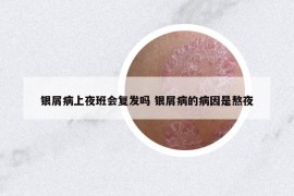 银屑病上夜班会复发吗 银屑病的病因是熬夜