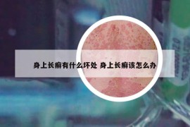 身上长癣有什么坏处 身上长癣该怎么办