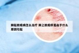 脚起脓疱病怎么治疗 脚上脓疱疹是由于什么原因引起