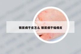 银屑病干皮怎么 银屑病干燥爆皮