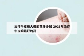 治疗牛皮癣大概能花多少钱 2021年治疗牛皮癣最好的药