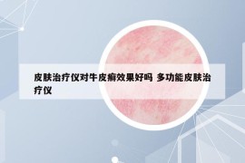 皮肤治疗仪对牛皮癣效果好吗 多功能皮肤治疗仪