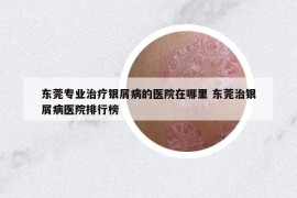 东莞专业治疗银屑病的医院在哪里 东莞治银屑病医院排行榜