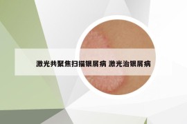 激光共聚焦扫描银屑病 激光治银屑病