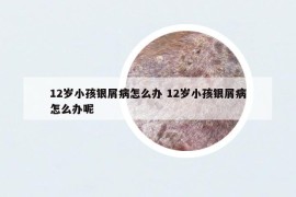 12岁小孩银屑病怎么办 12岁小孩银屑病怎么办呢