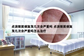 点滴银屑病复发几次会严重吗 点滴银屑病复发几次会严重吗怎么治疗