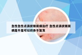 急性急性点滴状银屑病治疗 急性点滴状银屑病是不是可以终身不复发