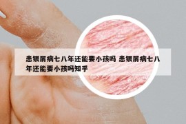 患银屑病七八年还能要小孩吗 患银屑病七八年还能要小孩吗知乎