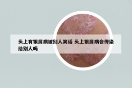 头上有银屑病被别人笑话 头上银屑病会传染给别人吗