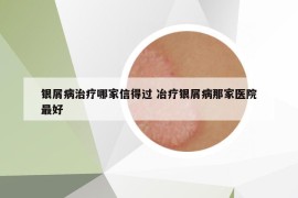 银屑病治疗哪家信得过 冶疗银屑病那家医院最好