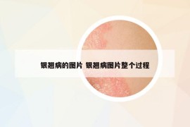 银翘病的图片 银翘病图片整个过程