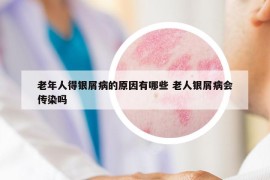 老年人得银屑病的原因有哪些 老人银屑病会传染吗