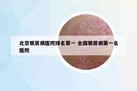 北京银屑病医院排名第一 全国银屑病第一名医院