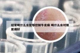 经常喝什么水能够控制牛皮癣 喝什么水对银屑病好