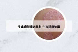 牛皮癣健康大礼包 牛皮肤癣论坛