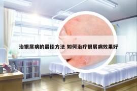 治银屑病的最佳方法 如何治疗银屑病效果好