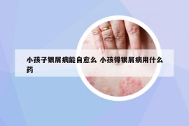 小孩子银屑病能自愈么 小孩得银屑病用什么药