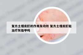 复方土槿皮酊的作用及功效 复方土槿皮酊能治疗灰指甲吗