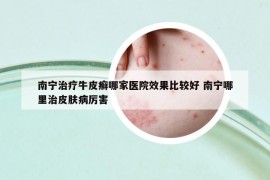 南宁治疗牛皮癣哪家医院效果比较好 南宁哪里治皮肤病厉害