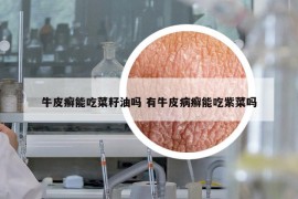 牛皮癣能吃菜籽油吗 有牛皮病癣能吃紫菜吗