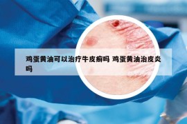 鸡蛋黄油可以治疗牛皮癣吗 鸡蛋黄油治皮炎吗