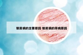 银屑病的主要原因 银屑病的得病原因