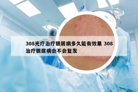 308光疗治疗银屑病多久能有效果 308治疗银屑病会不会复发