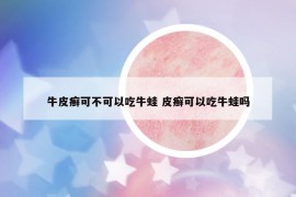 牛皮癣可不可以吃牛蛙 皮癣可以吃牛蛙吗