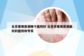 北京看银屑病哪个医院好 北京市看银屑病最好的医院和专家