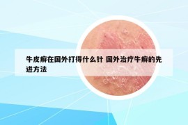 牛皮癣在国外打得什么针 国外治疗牛癣的先进方法