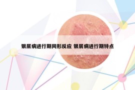 银屑病进行期同形反应 银屑病进行期特点