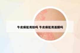 牛皮癣能用肽吗 牛皮癣能用面膜吗