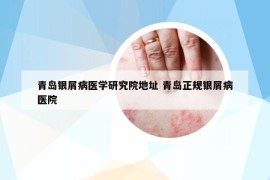 青岛银屑病医学研究院地址 青岛正规银屑病医院