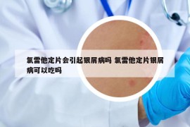 氯雷他定片会引起银屑病吗 氯雷他定片银屑病可以吃吗