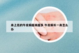 身上出的牛皮癣越来越多 牛皮癣长一身怎么办