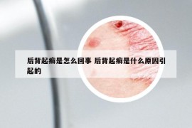 后背起癣是怎么回事 后背起癣是什么原因引起的