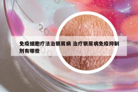 免疫细胞疗法治银屑病 治疗银屑病免疫抑制剂有哪些